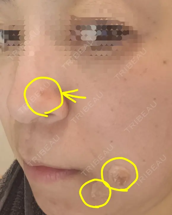 ほくろ・いぼ切除（肌） CLINIC W DAY 7 メイン用