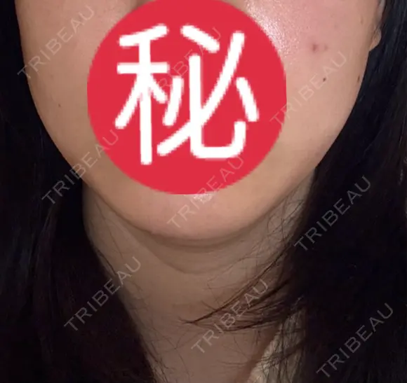 オンダリフト LIGHT CLINIC 【ライトクリニック】 名古屋院 DAY 1 メイン用