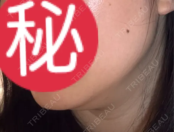 オンダリフト LIGHT CLINIC 【ライトクリニック】 名古屋院 DAY 1 メイン用