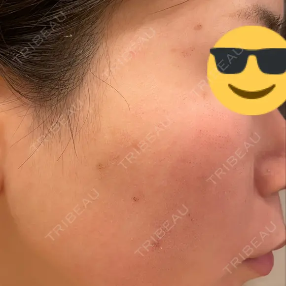 ルビーレーザー AZ BEAUTY CLINIC DAY 1 メイン用
