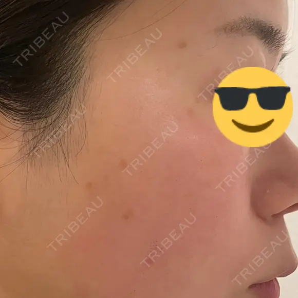 ルビーレーザー AZ BEAUTY CLINIC DAY 5 メイン用