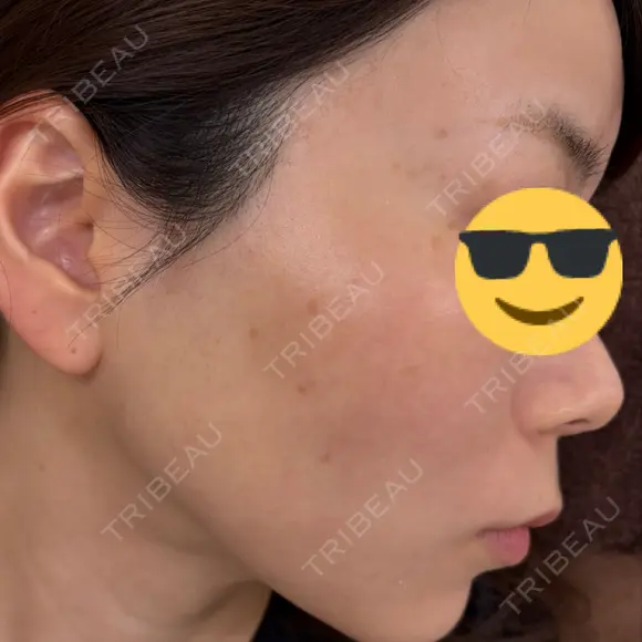 ルビーレーザー AZ BEAUTY CLINIC AFTER メイン用