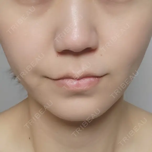 糸リフト 形成外科と美容外科のクリニック池袋 DAY 5 メイン用