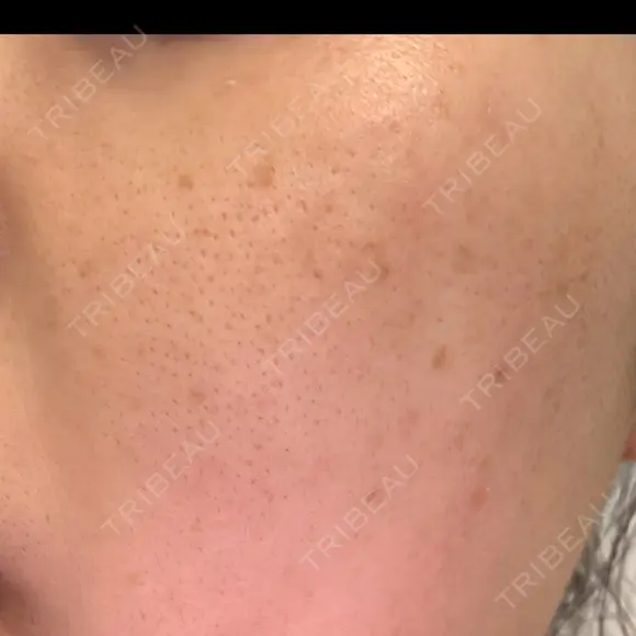ピーリング（ニキビ・毛穴） / ピコレーザートーニング（美白・肝斑） エトワールレジーナクリニック新宿院 DAY 2 メイン用