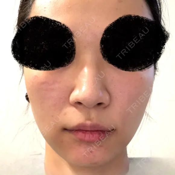 肌育注射（ジュベルックなど） CHARIS BEAUTY CLINIC AFTER メイン用