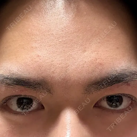 眼瞼下垂（切開） / 上まぶたの脂肪取り 新前橋かしま眼科形成外科クリニック AFTER メイン用