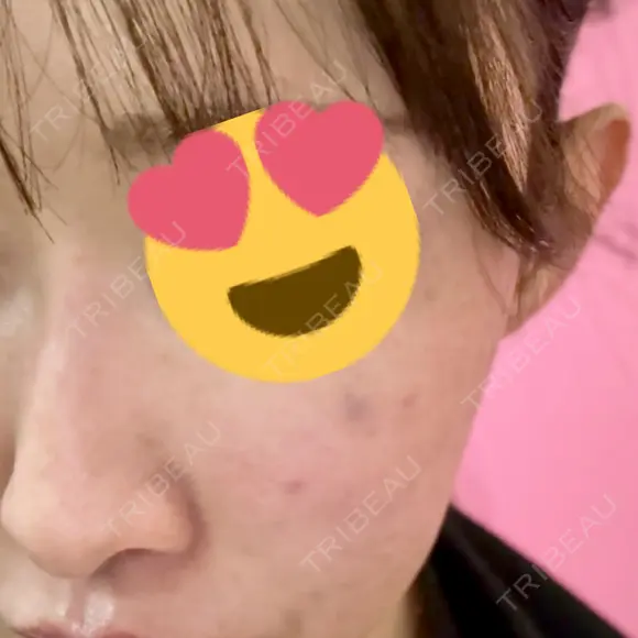 デンシティ Lumiera Clinic DAY 0 メイン用