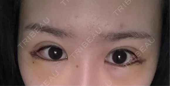 目尻切開 / タレ目形成・グラマラスライン（切開） BIANCA銀座 DAY 4 メイン用