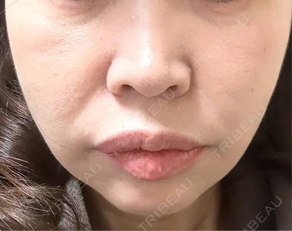 糸リフト / ボトックス（口角） 形成外科と美容外科のクリニック池袋 AFTER メイン用