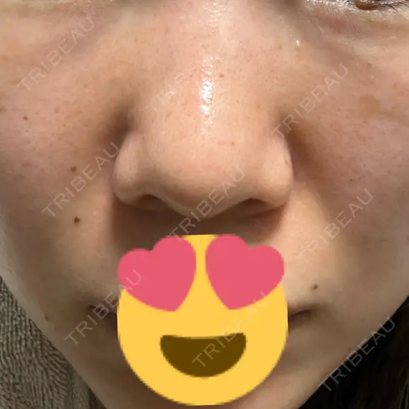 ニードルRF（ポテンツァなど） レナータクリニック 立川院 AFTER メイン用