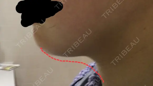 脂肪溶解注射（顔） / PRP皮膚再生療法 聖心美容クリニック 六本木院 AFTER メイン用