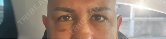 クマ治療 湘南美容クリニック 千葉センシティ院 DAY 5 メイン用