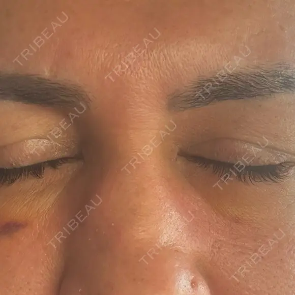 クマ治療 湘南美容クリニック 千葉センシティ院 DAY 5 メイン用