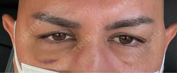 クマ治療 湘南美容クリニック 千葉センシティ院 DAY 6 メイン用