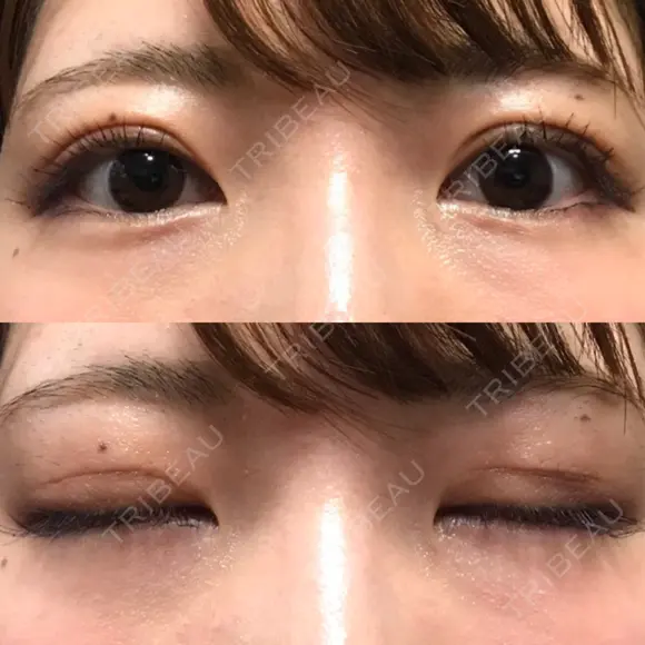眼瞼下垂（切開） / 上まぶたの脂肪取り 白山クリニック 大分 DAY 47 メイン用