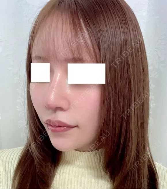 鼻尖形成（切開） / 軟骨移植 / 鼻修正 / 鼻孔縁挙上 / その他（鼻） WOM CLINIC GINZA （ワム クリニック ギンザ） DAY 7 メイン用