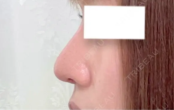 鼻尖形成（切開） / 軟骨移植 / 鼻修正 / 鼻孔縁挙上 / その他（鼻） WOM CLINIC GINZA （ワム クリニック ギンザ） DAY 7 メイン用