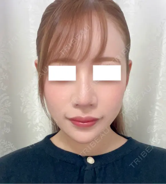 鼻尖形成（切開） / 軟骨移植 / 鼻修正 / 鼻孔縁挙上 / その他（鼻） WOM CLINIC GINZA （ワム クリニック ギンザ） DAY 8 メイン用