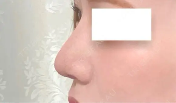 鼻尖形成（切開） / 軟骨移植 / 鼻修正 / 鼻孔縁挙上 / その他（鼻） WOM CLINIC GINZA （ワム クリニック ギンザ） DAY 8 メイン用