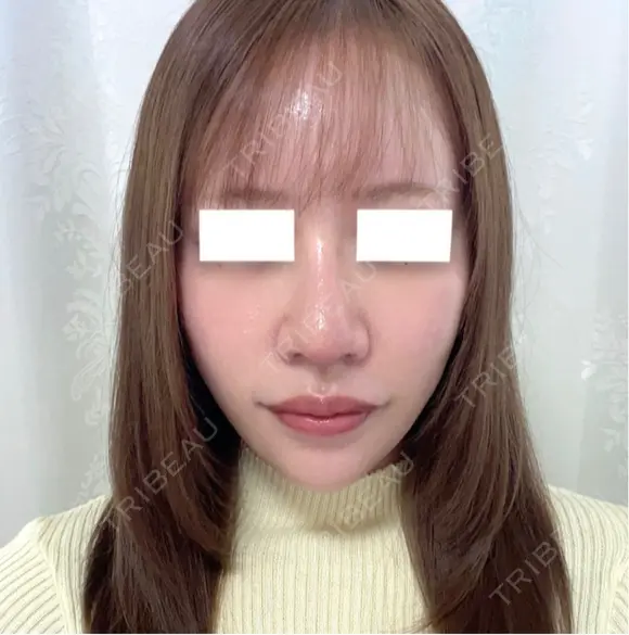 鼻尖形成（切開） / 軟骨移植 / 鼻修正 / 鼻孔縁挙上 / その他（鼻） WOM CLINIC GINZA （ワム クリニック ギンザ） DAY 7 メイン用