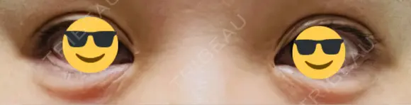 ヒアルロン酸注入（涙袋） / ヒアルロン酸注入（唇） / ボトックス（肩） / ボトックス（首） / シミ取りレーザー ルヴィクリニック イオンドーム前院 DAY 0 メイン用