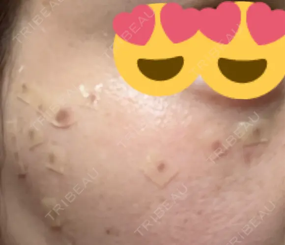 ヒアルロン酸注入（涙袋） / ヒアルロン酸注入（唇） / ボトックス（肩） / ボトックス（首） / シミ取りレーザー ルヴィクリニック イオンドーム前院 DAY 0 メイン用