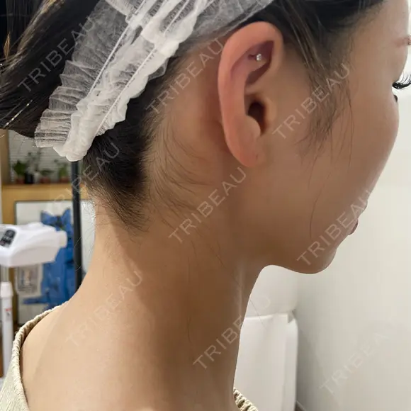 ピアス穴あけ 渋谷美容外科クリニック 新宿院 DAY 0 メイン用