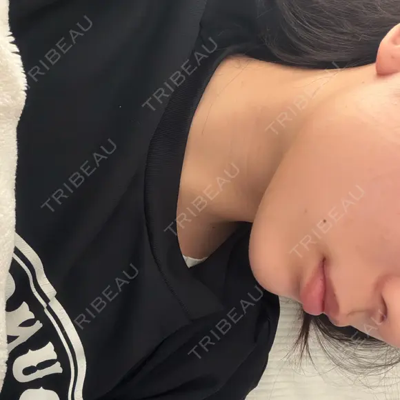 ボトックス（エラ・小顔） 小暮整形外科・美容外科 DAY 1 メイン用