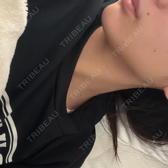 ボトックス（エラ・小顔） 小暮整形外科・美容外科 DAY 1 メイン用