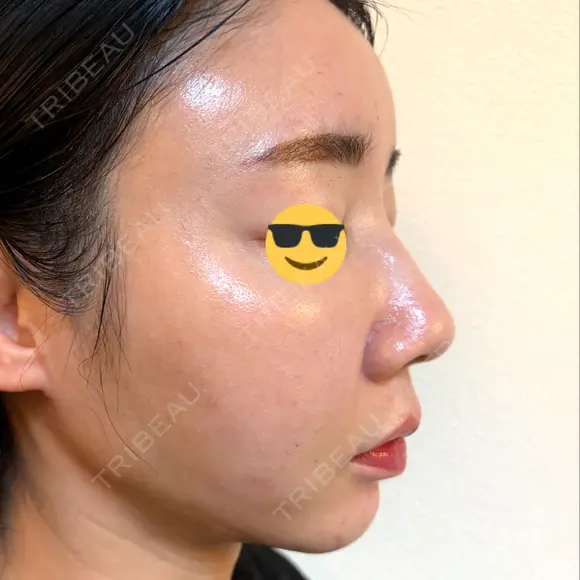 糸リフト / 脂肪吸引（顔） EMMA CLINIC（エマクリニック） DAY 14 メイン用