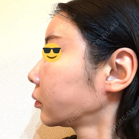 糸リフト / 脂肪吸引（顔） EMMA CLINIC（エマクリニック） DAY 14 メイン用