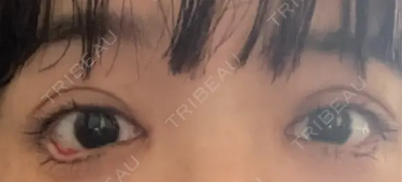 目尻切開 / タレ目形成・グラマラスライン（埋没） LOUIS CLINIC 二子玉川院【ルイクリニック】 DAY 1 メイン用