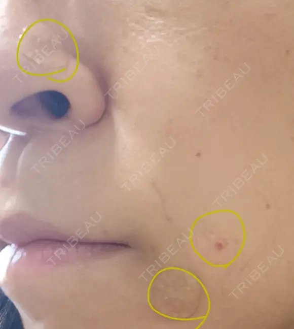 ほくろ・いぼ切除（肌） CLINIC W DAY 10 メイン用