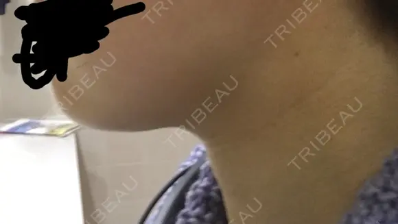 脂肪溶解注射（顔） / PRP皮膚再生療法 聖心美容クリニック 六本木院 DAY 27 メイン用