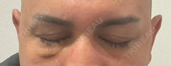 クマ治療 湘南美容クリニック 千葉センシティ院 AFTER メイン用