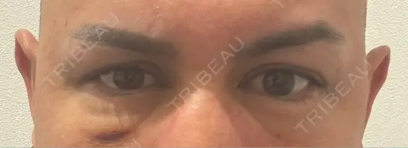 クマ治療 湘南美容クリニック 千葉センシティ院 DAY 7 メイン用