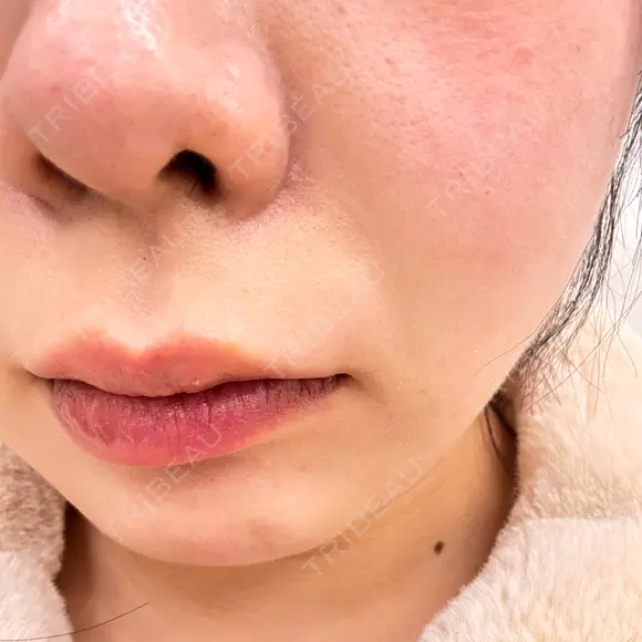 マイクロボトックス Natural Skin Clinic 自由ヶ丘院 DAY 1 メイン用