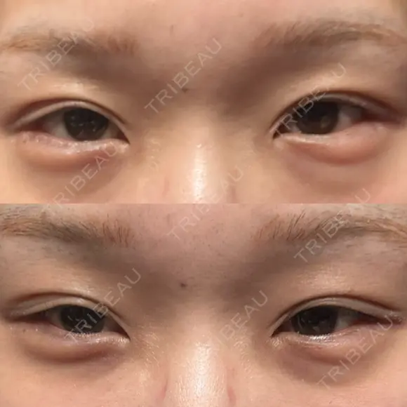 ヒアルロン酸注入（涙袋） 小倉美容外科/美容皮膚科 ビラビューティークリニック DAY 1 メイン用