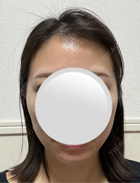 糸リフト / ボトックス（エラ・小顔） アリエル美容クリニック 水戸院 DAY 23 メイン用