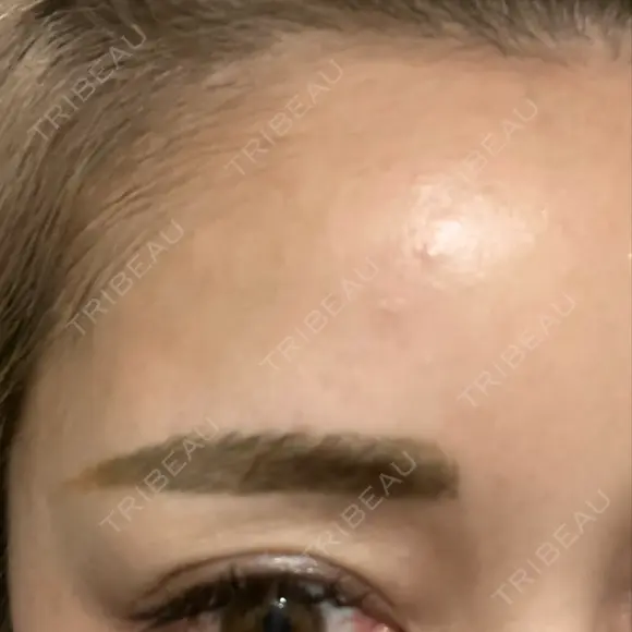 ピコレーザートーニング（美白・肝斑） / ピコフラクショナルレーザー（毛穴・ニキビ跡） しんゆり美容健康クリニック DAY 1 メイン用