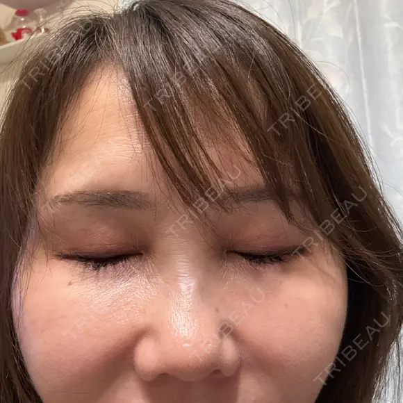 水光注射（ハリ・美肌） / ハイフ（首） しんゆり美容健康クリニック DAY 34 メイン用