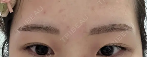アートメイク（眉） G MEDICAL ART クリニック 新宿院 AFTER メイン用