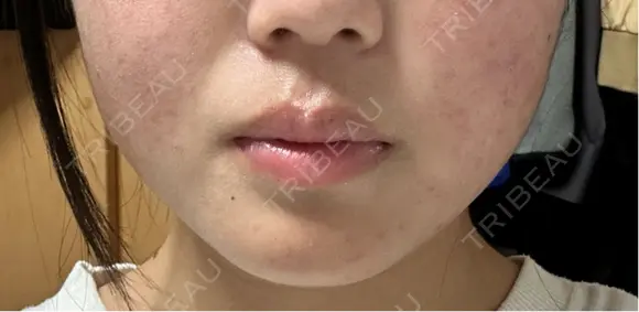 ボトックス（あご） / ボトックス（エラ・小顔） / ボトックス（口角） STELLA LUNNA CLINIC DAY 0 メイン用