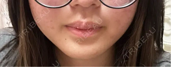 ボトックス（あご） / ボトックス（エラ・小顔） / ボトックス（口角） STELLA LUNNA CLINIC DAY 1 メイン用