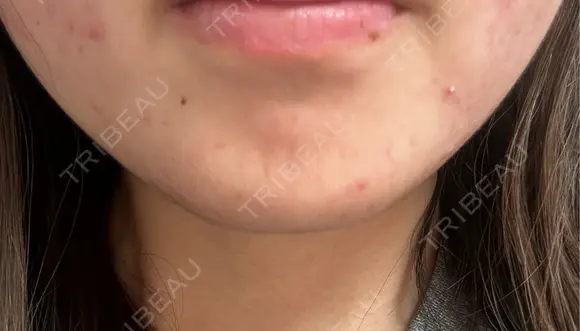 ボトックス（あご） / ボトックス（エラ・小顔） / ボトックス（口角） STELLA LUNNA CLINIC DAY 1 メイン用