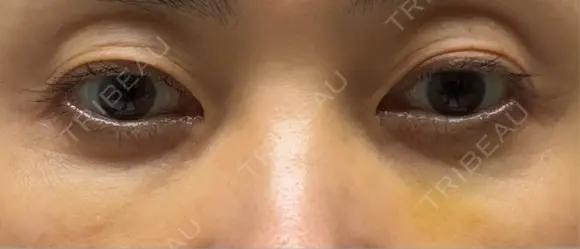 スネコス 札幌美容外科ネビュラクリニック DAY 10 メイン用