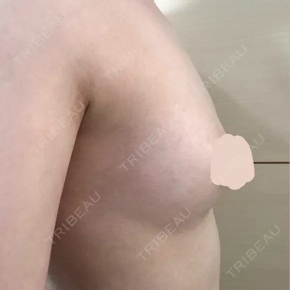 豊胸（脂肪注入） 銀座マイアミ美容外科 DAY 61 メイン用