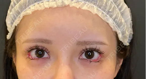 目尻切開 / タレ目形成・グラマラスライン（埋没） LOUIS CLINIC 二子玉川院【ルイクリニック】 DAY 0 メイン用