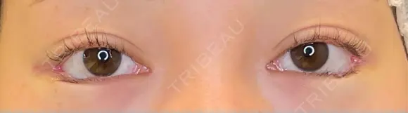 目尻切開 / タレ目形成・グラマラスライン（埋没） LOUIS CLINIC 二子玉川院【ルイクリニック】 DAY 0 メイン用