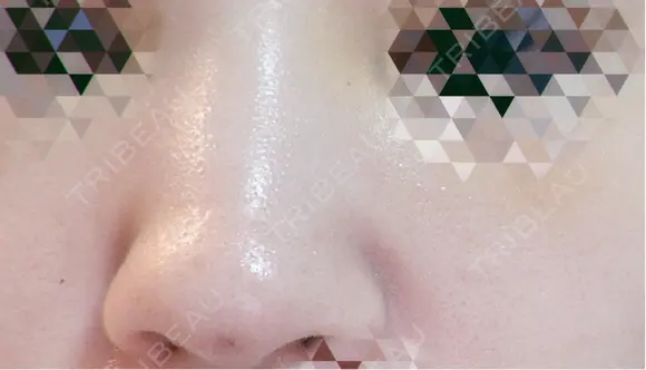 隆鼻術 形成外科と美容外科のクリニック池袋 DAY 2 メイン用